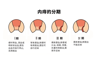 内痔的分级