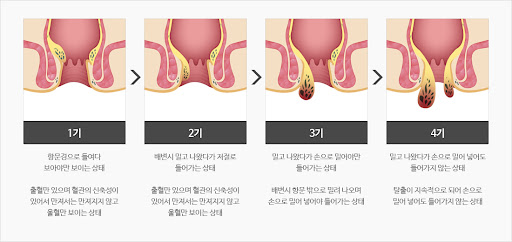 치질의 종류