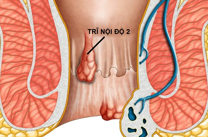 2기 치핵은 배변 시 치핵 조직이 탈출되지만, 저절로 다시 들어가는 상태입니다