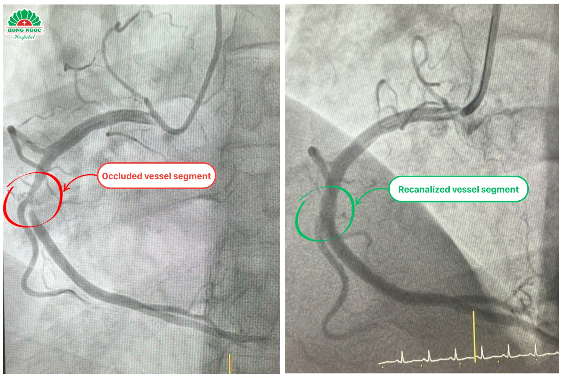 ĐOẠN MẠCH HẸP NẶNG (2)