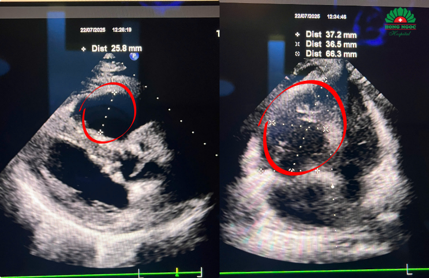 Đoạn Mạch Bị Tắc (17)