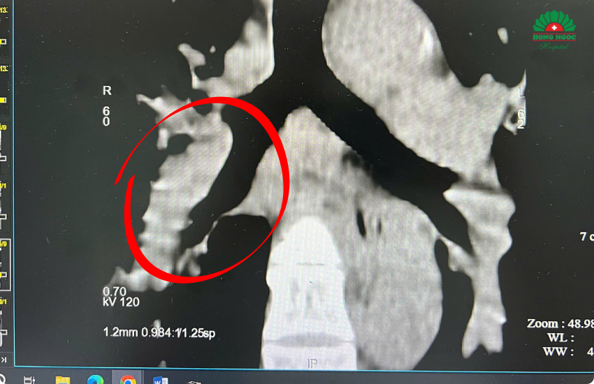 Đoạn Mạch Bị Tắc (18)