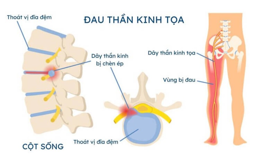 Chèn ép rễ thần kinh tọa gây đau lan dọc xuống mông và chân