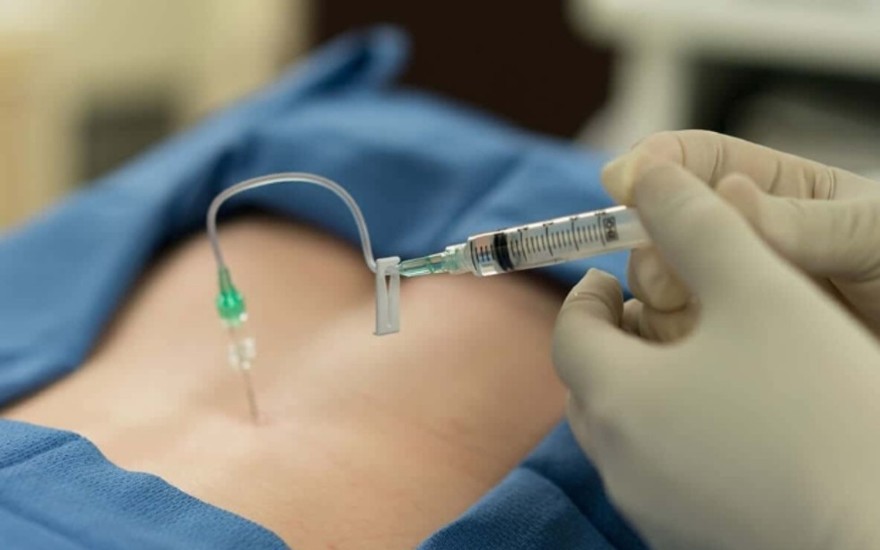 Tiêm ngoài màng cứng giúp giảm đau lưng và tê bì chân do thoát vị đĩa đệm