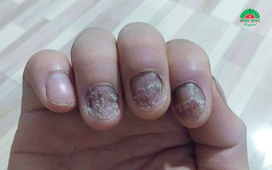 nấm móng