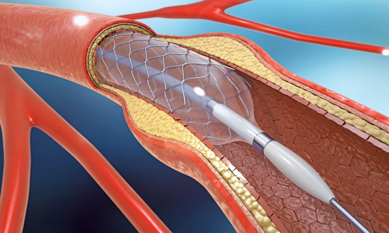 20220909 Stent Duong Mat 1