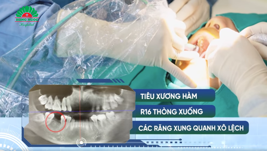 trồng implant phục hình mất răng