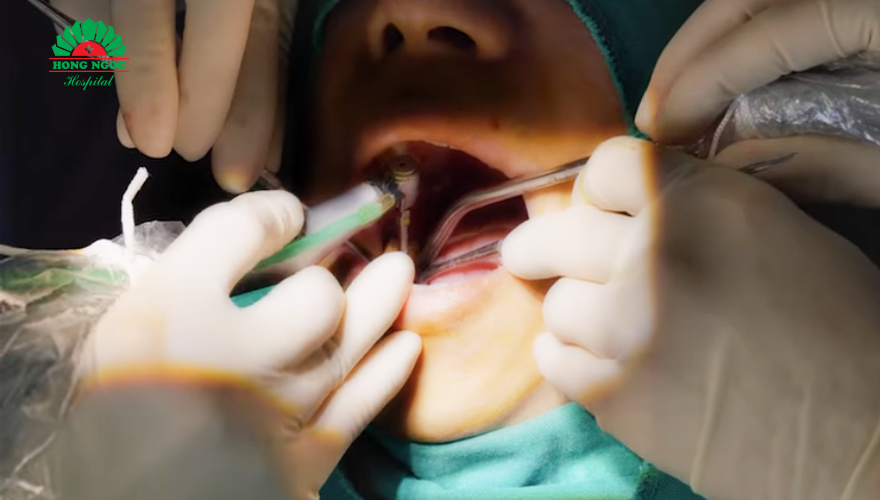 trồng răng implant