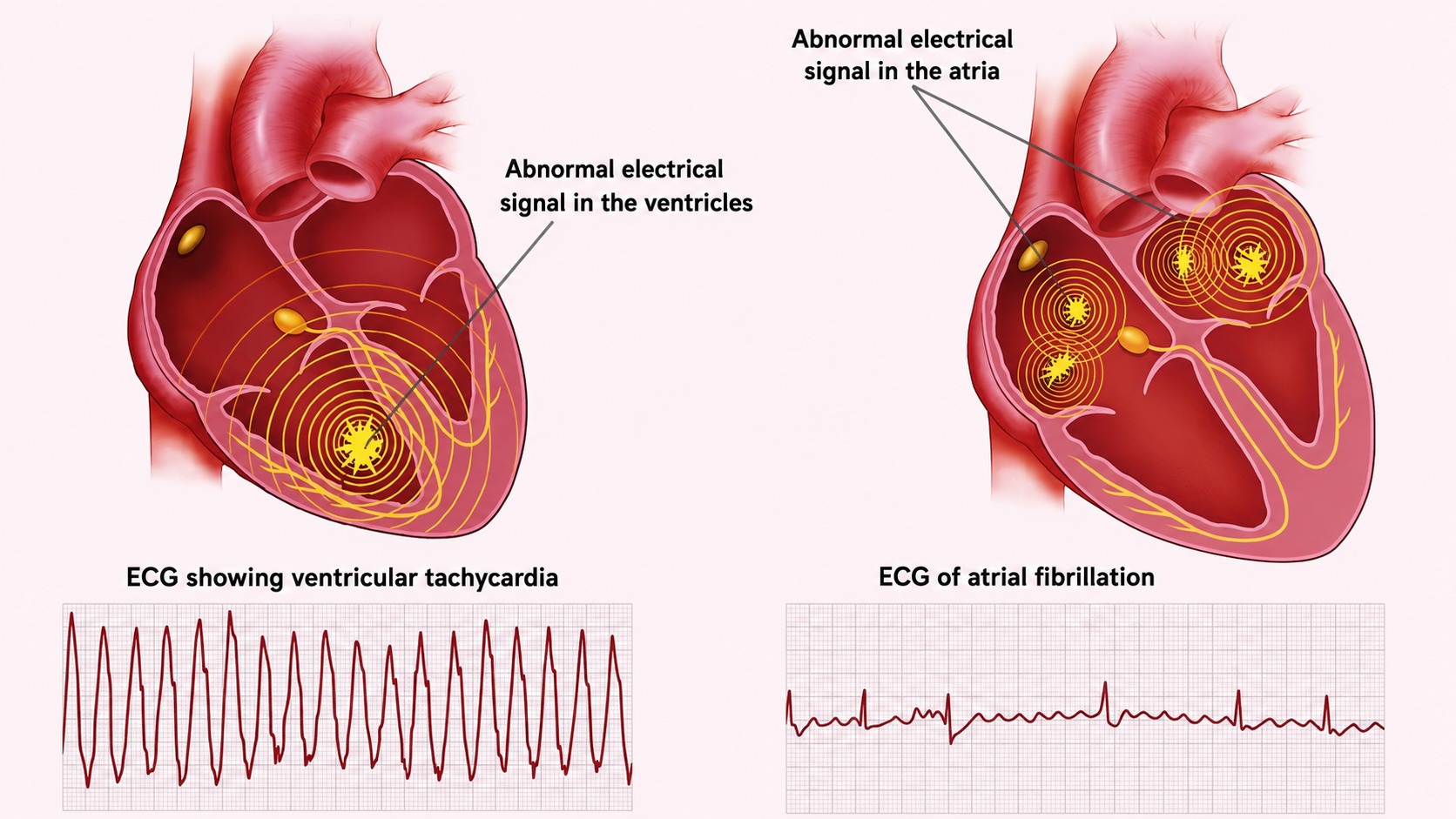Atrial fibrillation may increase the risk of blood clot formation.