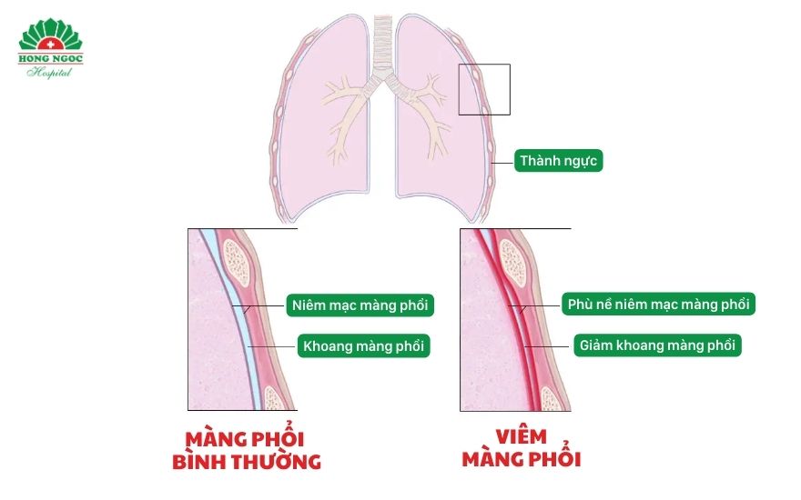Viêm màng phổi ở trẻ em chủ yếu do vi khuẩn, virus gây nên