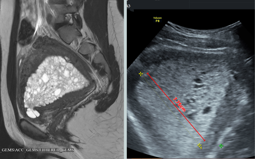 19 tuổi đối mặt ung thư