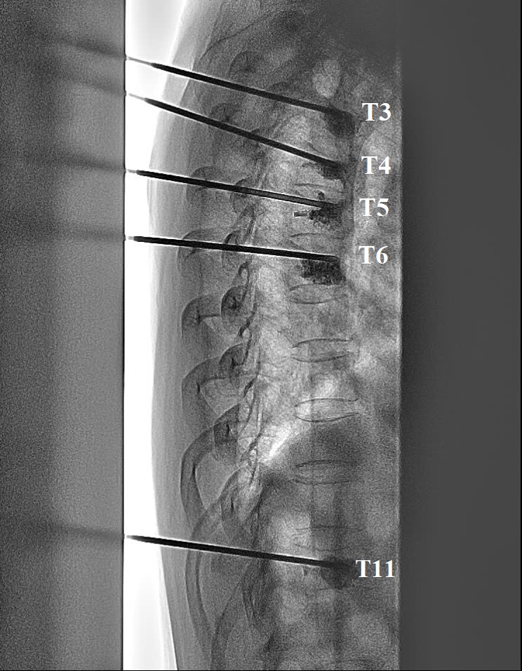 bơm xi măng sinh học