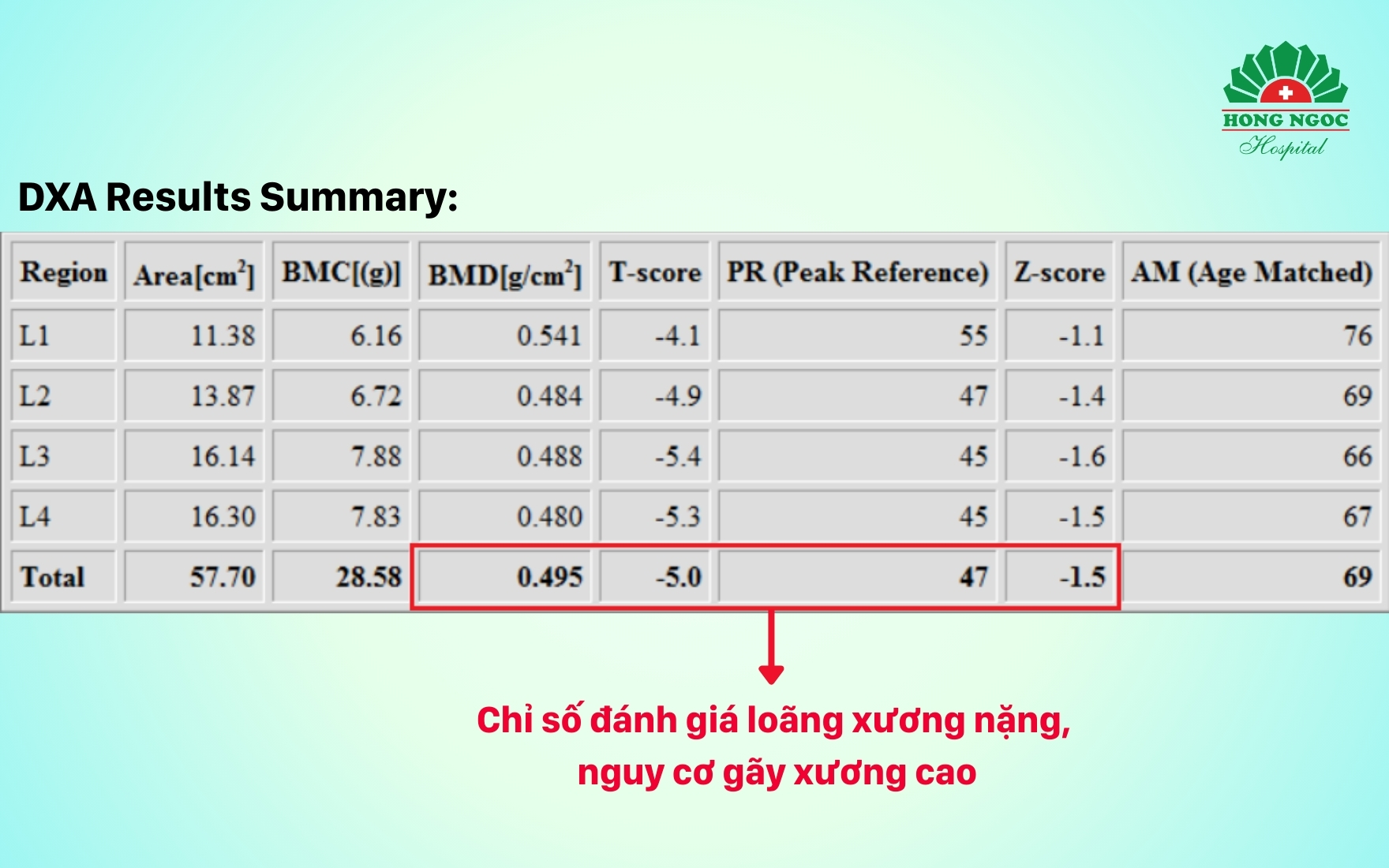 Kết quả đo loãng xương phát hiện loãng xương nặng