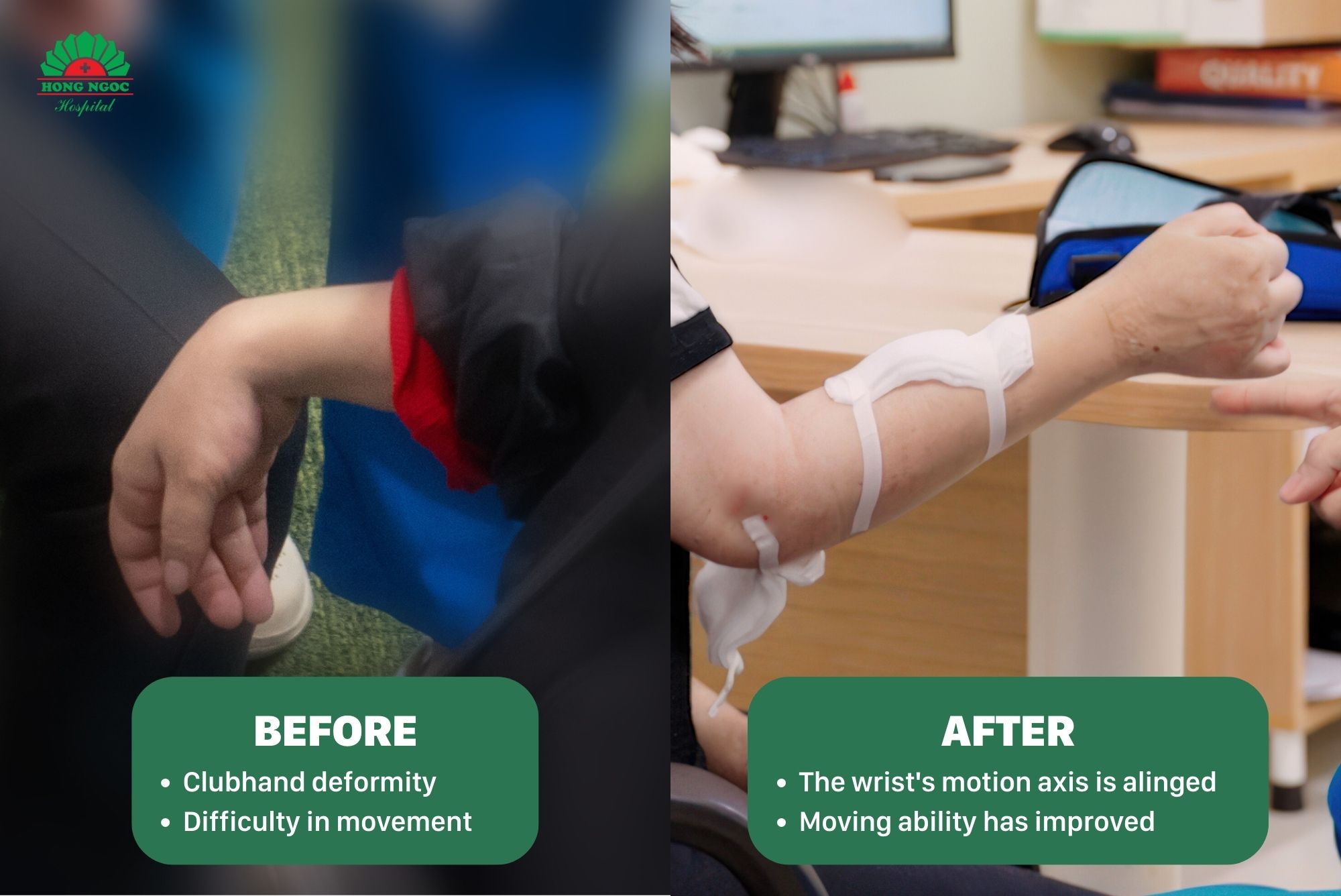 Tran Khanh Linh before and after surgery 