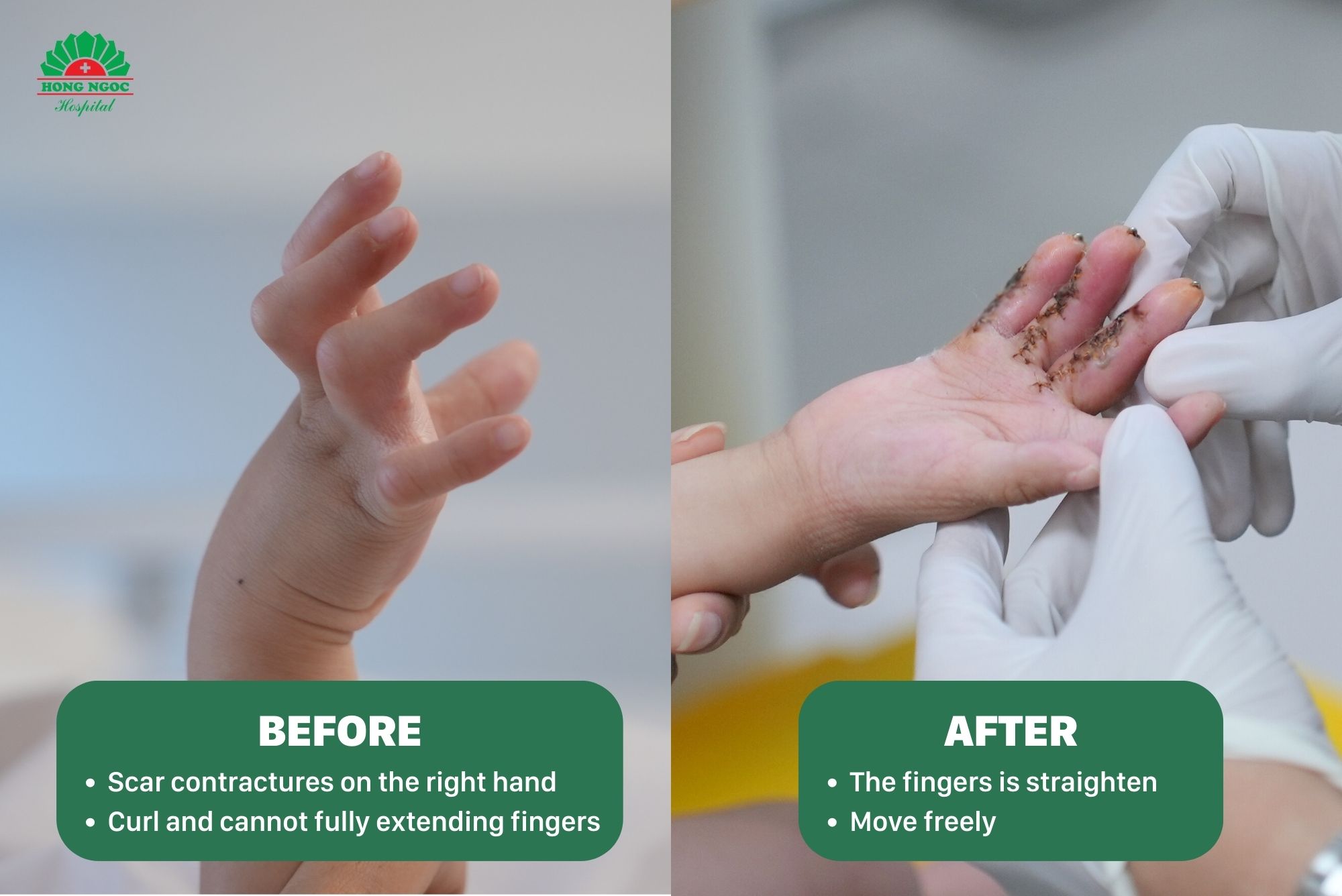 Le Nguyen Nhat Linh before and after surgery