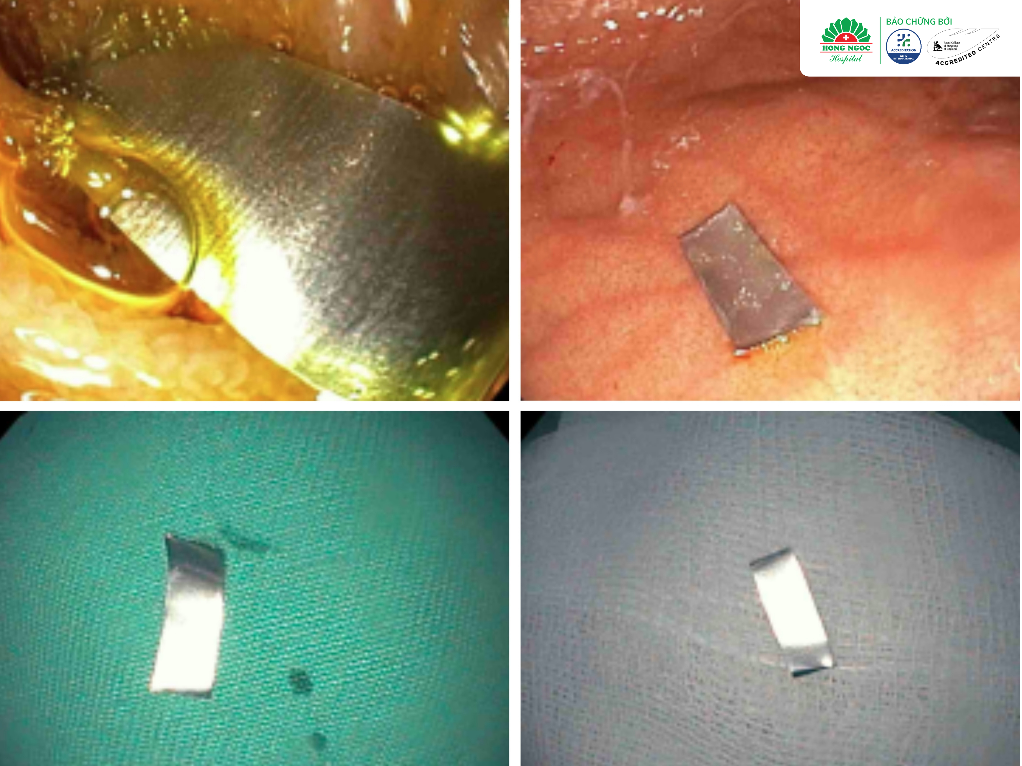 Cảnh Báo Trẻ Nuốt Dị Vật (3)