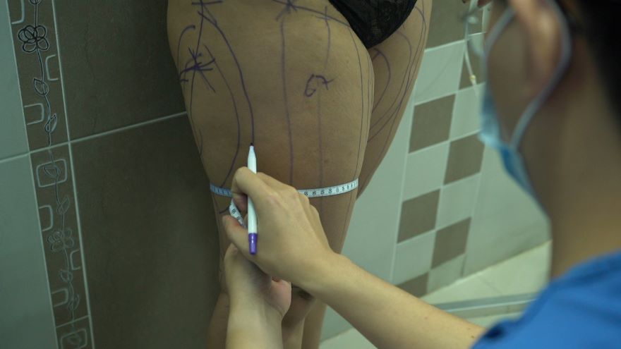 hút mỡ đùi Vaser Lipo