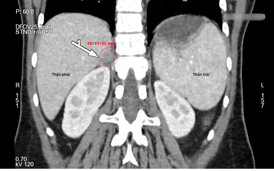 Computed tomography imaging demonstrated a right adrenal mass measuring approximately 23 × 11 × 22 mm.
