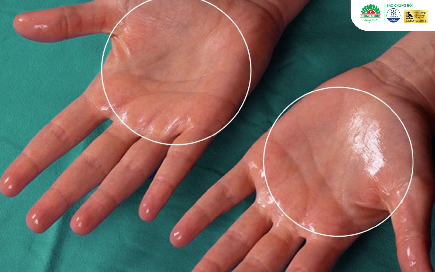 Hô Hấp   Bài Quốc Tế (4)