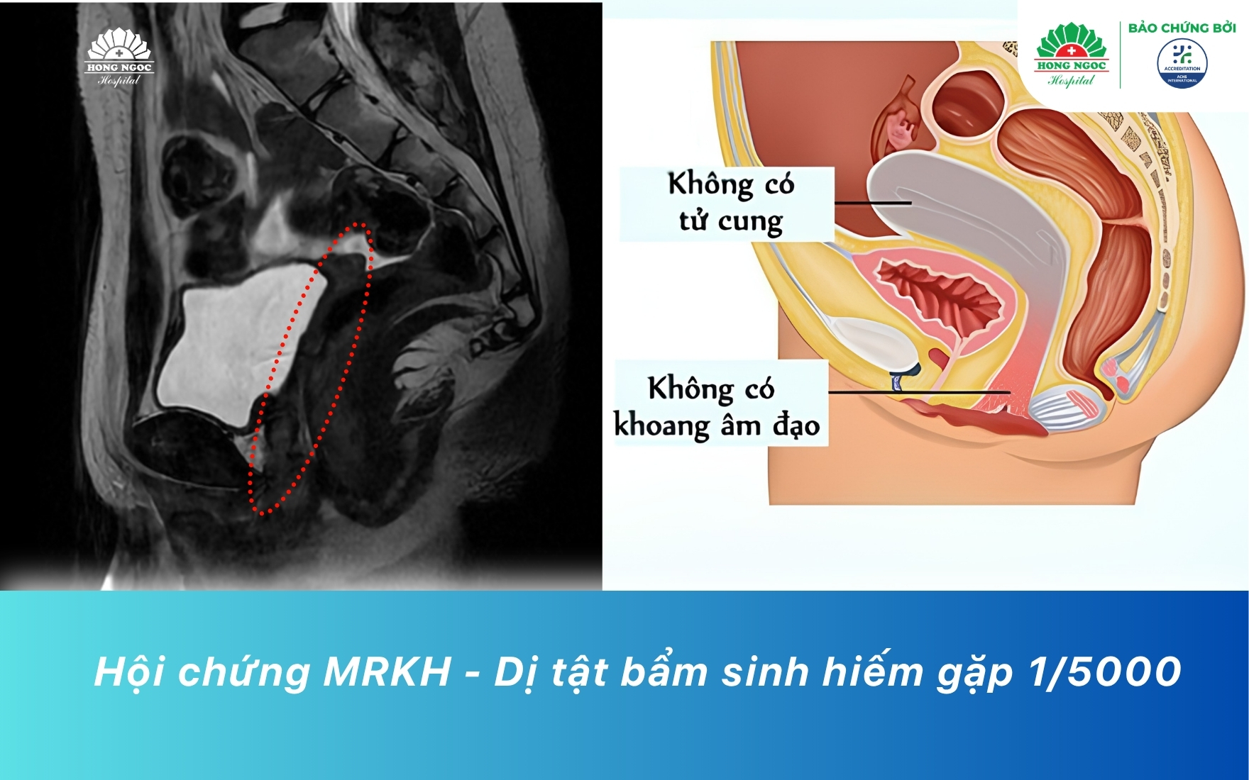 Hình ảnh chẩn đoán bệnh nhi mắc hội chứng MRKH, không có tử cung