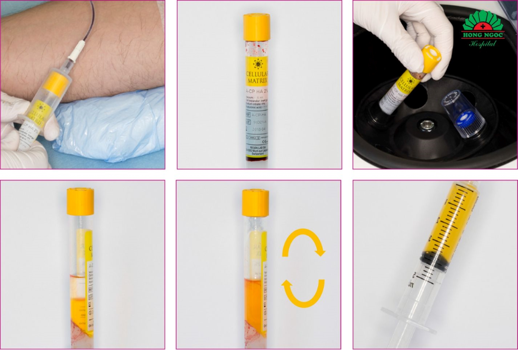 Liệu pháp tiêm PRP kết hợp HA - mũi tiêm “2 trong 1”