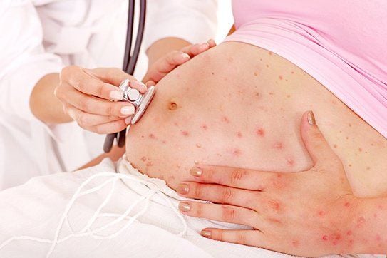 bà bầu bị sởi