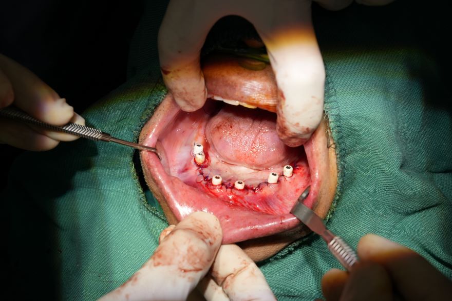 Implant phục hình toàn hàm All On 6