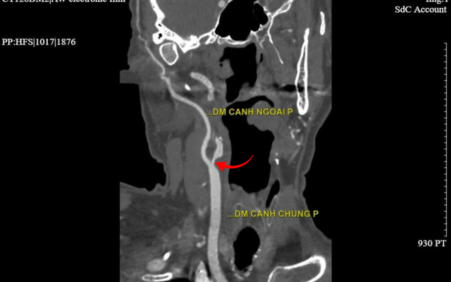 The site of carotid artery stenosis on the 2560-slice CT imaging.