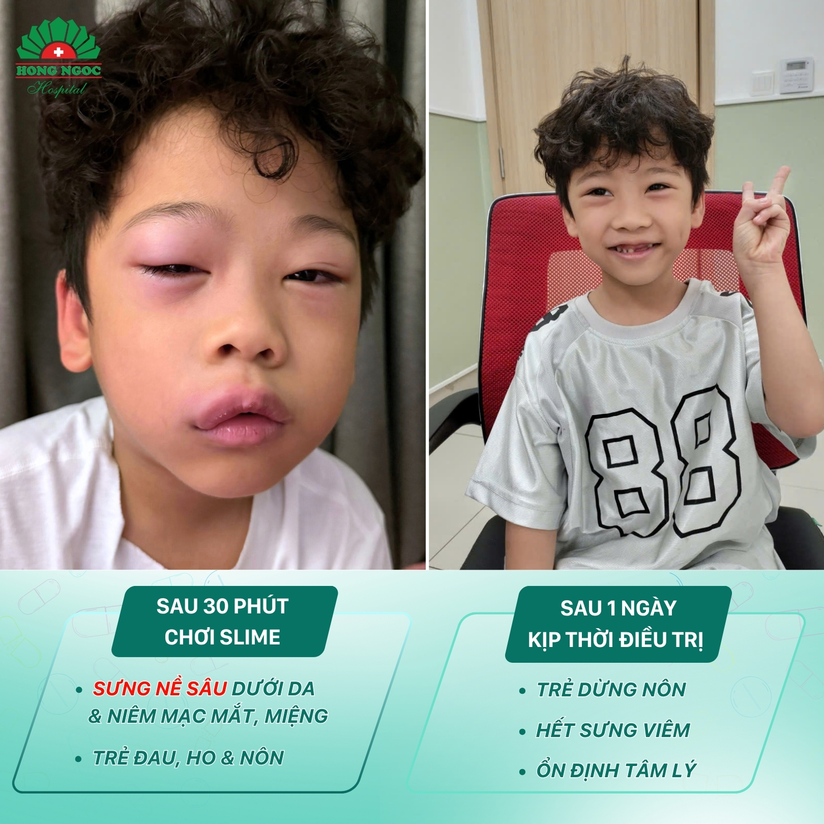 Bé trai 5 tuổi cấp cứu do phù mạch sau 30 phút chơi slime (chất nhờn ma quái)