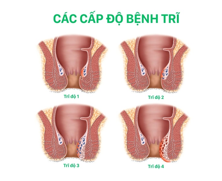 Cach Dieu Tri Benh Tri Tai Nha 3