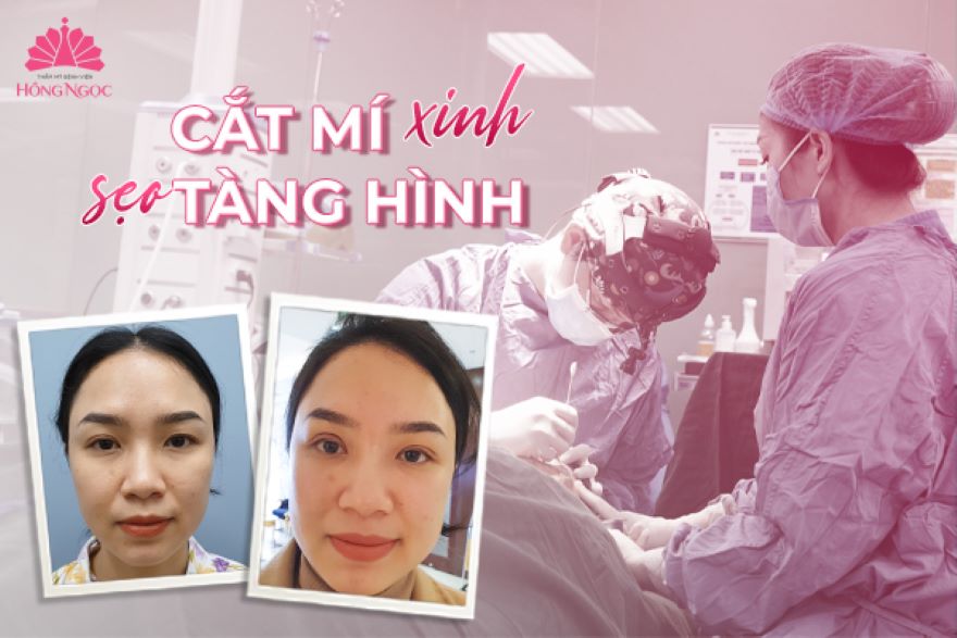 cắt mắt 2 mí