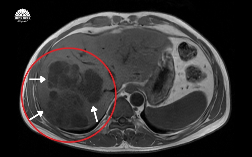 chum-ap-xe-gan-khong-lo-gay-nhiem-khuan-huyet