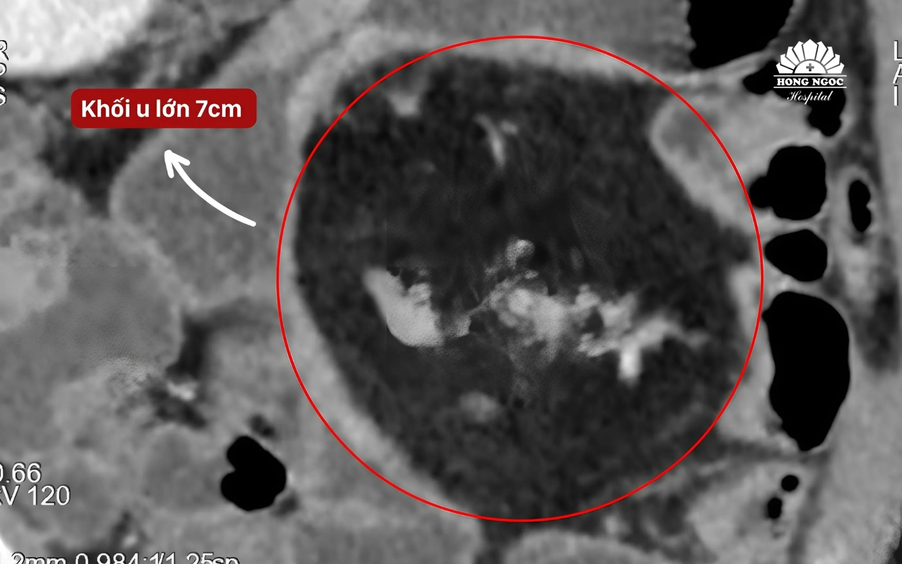 dau-bung-dai-dang-do-u-mac-treo-ruot-non