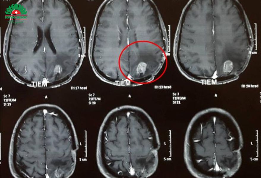 dấu hiệu nhận biết u não