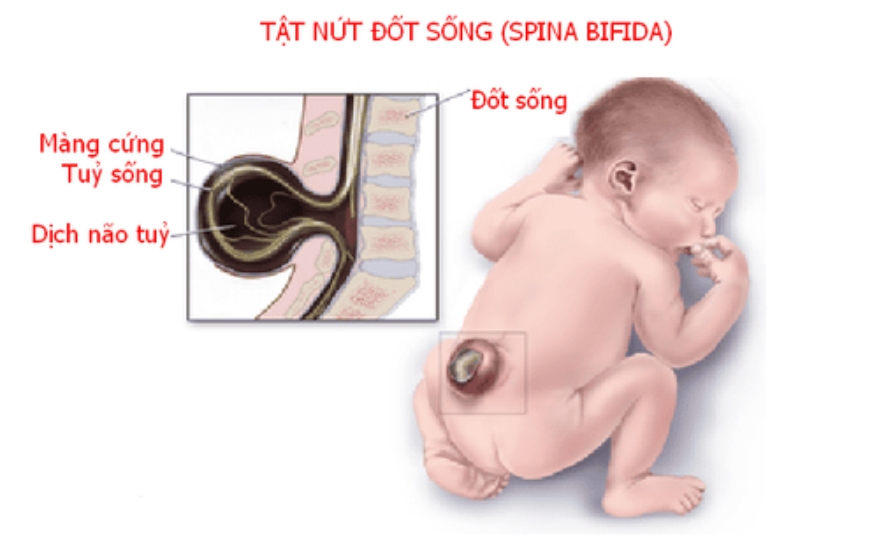 Dị tật bẩm sinh