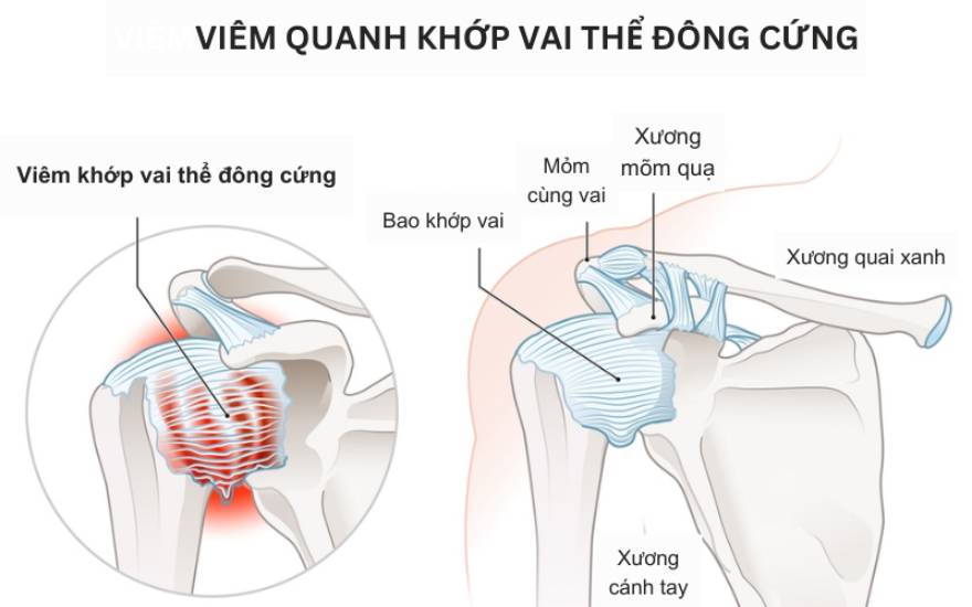 đông cứng khớp vai