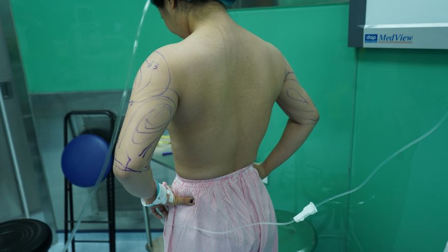 hút mỡ bắp tay