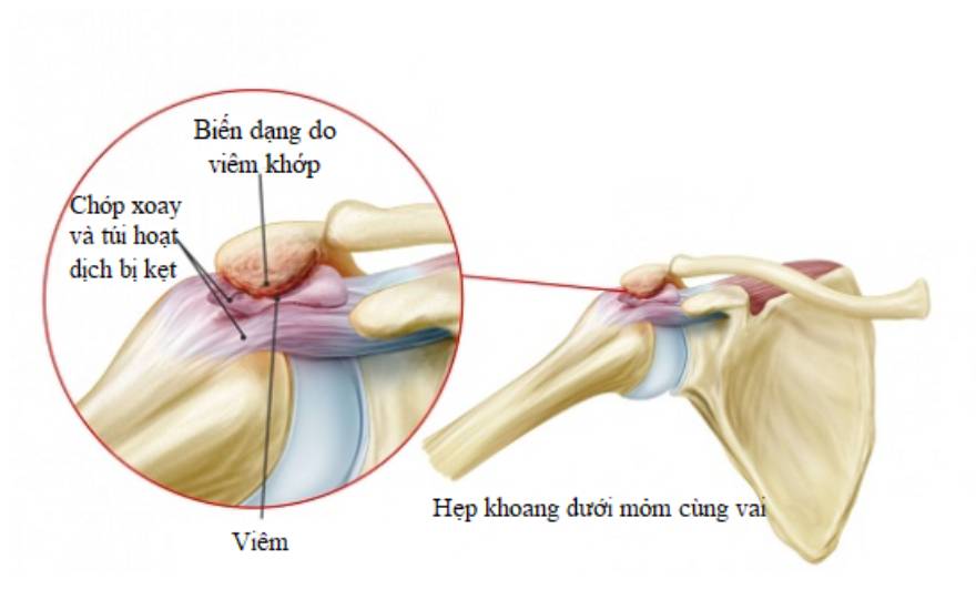 hội chứng hẹp khoang dưới mỏm cùng vai