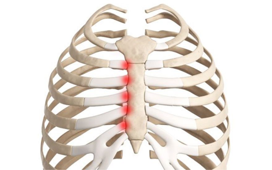 Hội chứng Tietze