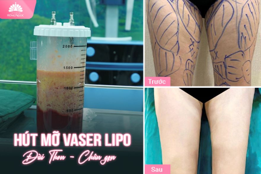 hút mỡ đùi Vaser Lipo