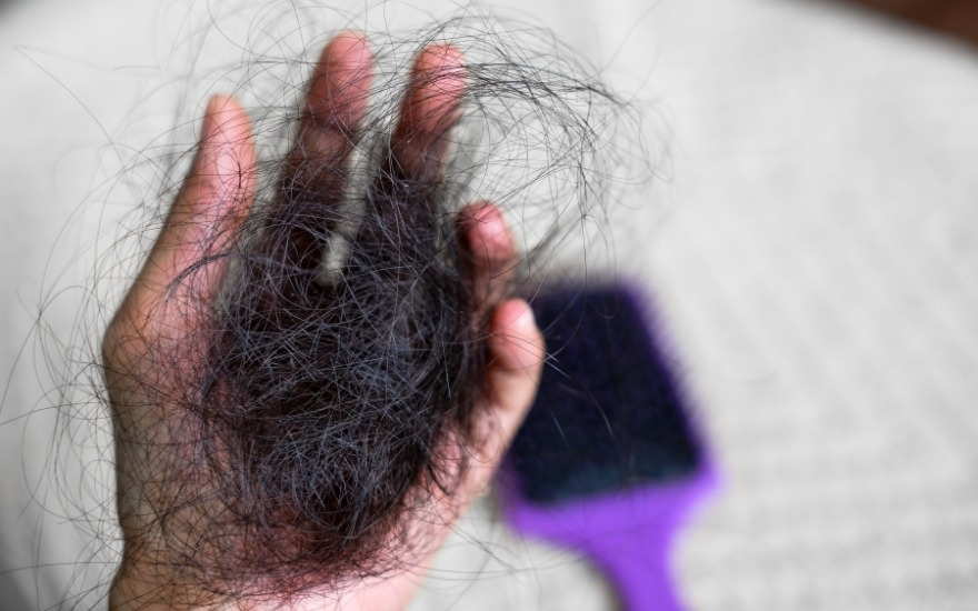 Rụng tóc nhiều có thể là biểu hiện của suy giáp