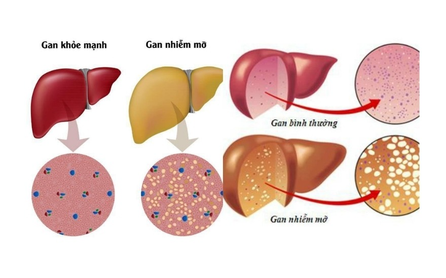 Gan nhiễm mỡ nên đi khám sớm