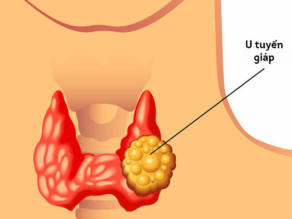 Nguyên nhân gây u tuyến giáp lành tính