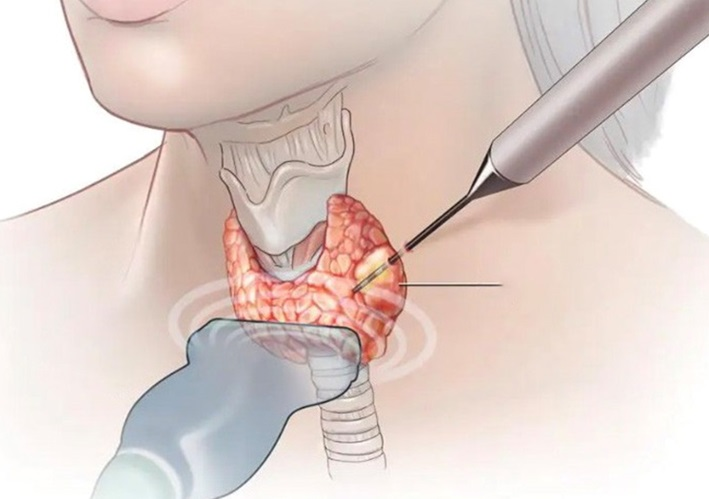 Phương pháp chọc hút tế bào để phân biệt chính xác u lành tính và u ác tính