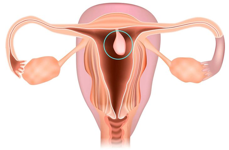 Các polyp ở tử cung và cổ tử cung xuất hiện do sự phát triển các mô nội mạc quá mức 