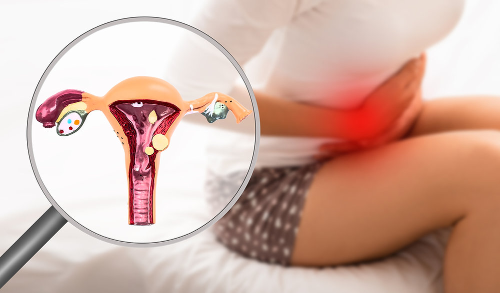Lạc nội mạc tử cung thường gây chảy máu vùng kín bất thường, rong kinh, viêm nhiễm&nbsp; 