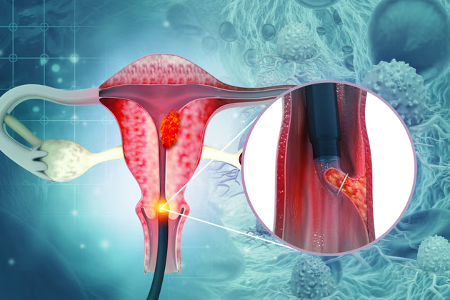 Vô sinh là tình trạng có thể xảy ra nếu chị em bị hội chứng buồng trứng đa nang (PCOS), u xơ tử cung, lạc nội mạc tử cung và viêm vùng chậu (PID) 