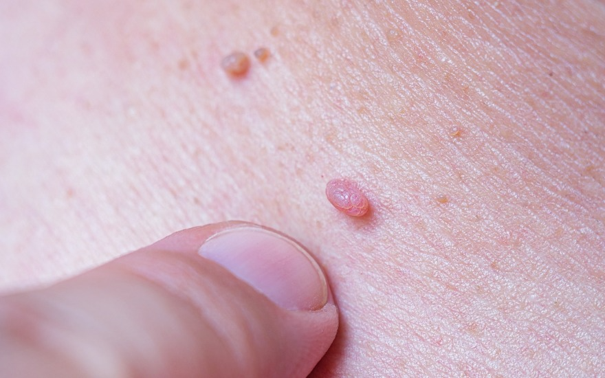 HPV có thể gây mụn cóc ở da