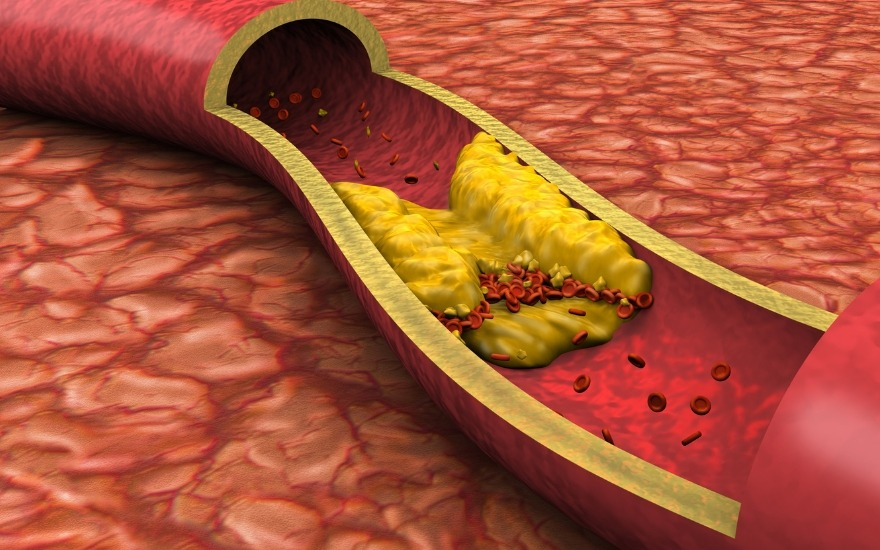 Người bệnh tim mạch nên xây dựng chế độ ăn giảm cholesterol “xấu”