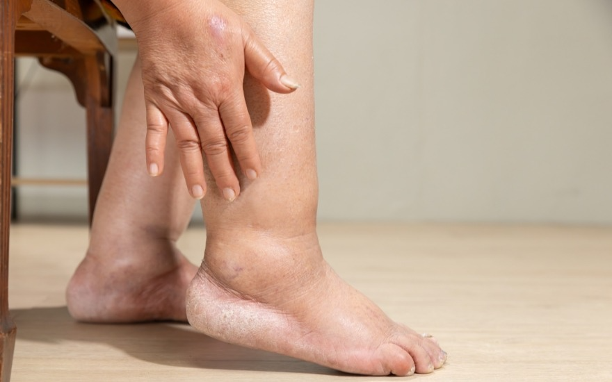 Phù chân do tích nước ở người suy tim ăn mặn 